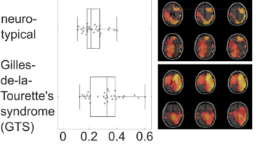 Hyperbinding & Tourette Syndrome